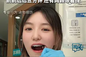 太“狠”了！#03年女牙医拿起铁钳自己动手拔智齿 #牙齿🦷  “前前后后只花了五分钟！” @.0  （记者：夏奕炀）#口腔医生 #牙医日常 #女大学生视频封面