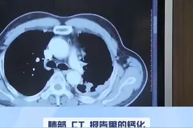 肺部ct报告里的钙化与空洞代表肺癌吗视频封面