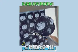 输尿管狭窄导致肾积水，左肾跟吹了一个气球一样 #肾结石 #输尿管狭窄 #微创手术 #硬核健康科普行动  #医疗健康创作训练营视频封面
