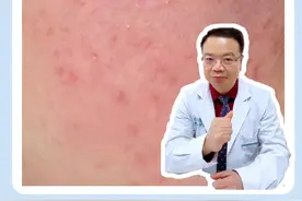 红脸蛋能不能打光子，为什么？#皮肤科医生谢红付 #玫瑰痤疮 #光子视频封面
