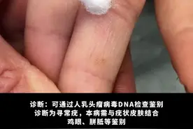 液氮去疣很痛，教你一个在家也能处理的妙招#科普  #HPV  #跖疣  #寻常疣  #健康