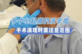 多中心起源的沃辛瘤，清理时需注意范围#沃辛瘤 #腺淋巴瘤 #腮腺肿瘤 #杨雯君视频封面