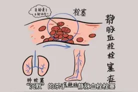 科普丨静脉血栓栓塞视频封面