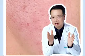 跑步脸红，尴尬脸红，吵架脸红，温度变化也脸红，易脸红体质怎么改善？#皮肤科医生谢红付 #脸红体质 #玫瑰痤疮视频封面