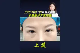 双眼皮调整＋外切眼袋(上) #割眼袋手术 #双眼皮修复 #眼修复 #眼袋视频封面