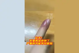 #倒刺千万不能拔  #一到冬天特别容易长倒刺  长倒刺一碰就疼，还影响美观，一些人身旁没有指甲刀时，会选择直接撕掉或拔掉。手指末梢神经丰富，如果贸然撕掉倒刺，不仅会产生刺痛感，操作不当还可能造成急性甲沟炎，导致流脓流血，严重的甚至出现败血症。视频封面