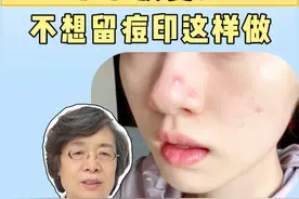 脸上的痘痘反复长，还留下了很多难看的痘印，今天医生教你正确处理#医学科普 #痘痘 #异维A酸软胶囊 #科普视频封面