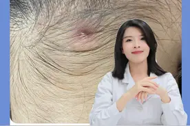 头上长痘痘，一碰就痛！千万别抠，小心头上秃一块#医学科普 #毛囊炎 #健康科普 #头皮毛囊炎视频封面