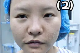 双眼皮修复+鼻修复 鼻修复术前方案设计#鼻修复 #何林医生 #手术 #医疗创作者培优计划视频封面