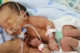 罕见！浙江联体婴姐妹成功“分离”，医生：是时候“分离”了，姐姐长得快，经常踢打妹妹......（供稿：钱江视频）#浙江dou知道 视频封面