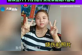 27岁女子意外被烧伤住进ICU，治疗已花费十多万，后续五六十万的治疗费让家庭陷入困境#中国节气立春篇  #过年全家福大比拼 #媒体精选计划视频封面