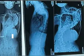 13岁重度脊柱侧弯的女孩 #脊柱侧弯 #Halo头环牵引 #抖音知识年终大赏视频封面