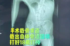 脊柱侧弯的日子到头了，接下来是崭新的人生 #脊柱侧弯 #青少年脊柱侧弯 #手术室你不知道的事视频封面