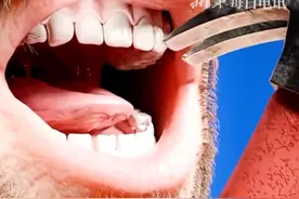 牙齿缺失一小块时该怎么办？动画呈现全过程，超治愈视频封面