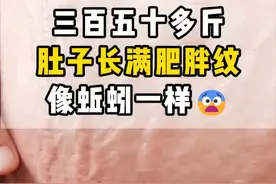 忽胖忽瘦，小心肥胖纹找上你！ #膨胀纹 #肥胖纹 #减肥 #肥胖 #减重手术