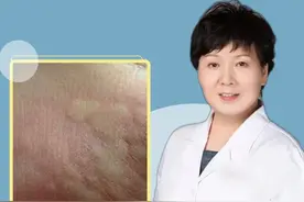 为什么会得荨麻疹？ 离不开这4点 #荨麻疹 #皮肤病视频封面