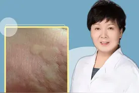 为什么会得荨麻疹？ 离不开这4点 #荨麻疹 #皮肤病