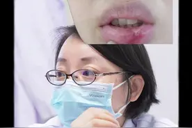 20年反复口腔溃疡老不好 可能是这些原因 #免疫病 #门诊故事 #口腔溃疡