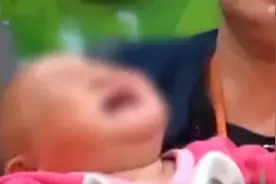 女孩体内惊现12根针