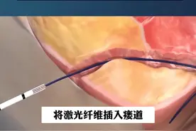 3D动画演示，肛瘘的激光治疗术。#成都肛肠专科医院 #医学科普 #3D动画演示 #肛瘘 #硬核健康科普行动视频封面