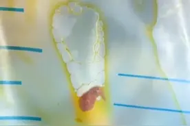 惊悚！广西一女子体内爬出一只只活虫，只因砧板、菜刀等厨房用品未做生、熟食区分#食品安全 #令人不敢尝试的奇葩美食 #肝吸虫 #鱼生 #广西视频封面