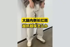 大腿内侧长红斑，天热出汗非常痒，越抓越痒#股癣怎么办#医学科普#男性健康 #真菌感染#酮康唑乳膏