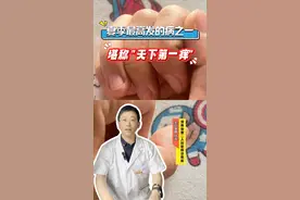 夏季最高发的病之一，堪称 "天下第一痒"  #汗疱疹 #医疗健康创作训练营 #抖出健康知识宝藏