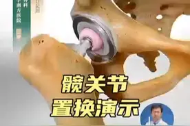 髋关节置换手术过程动画 #股骨头坏死  #抖出健康知识宝藏   #内容启发搜索视频封面