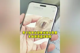 男子指甲出现黑线担心恶黑 未做病理直接截肢 #肿瘤免疫博士汪治宇 #恶性黑色素瘤 #门诊故事 @抖音医疗健康小助手视频封面