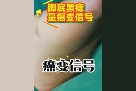 脚底有黑痣是癌变的信号吗？#黑痣 #脚底黑痣 #黑痣需要切除吗 #硬核健康科普行动  #刘新海医生视频封面