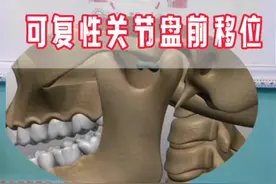 可复性关节盘前移位，怎么治？ #抖出健康知识宝藏 #健康科普 #口腔健康 #颞下颌关节紊乱 #可复性关节盘前移位视频封面