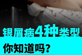 银屑病4种类型！你知道吗？很多牛皮癣患者轻信“偏方”，误入“小广告”的陷阱。关于牛皮癣，你真的了解吗？！（央视频号：#央视财经中国好医生  ）