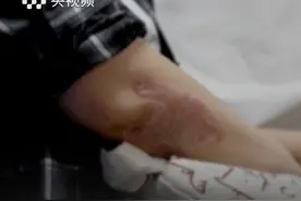 银屑病4种类型！你知道吗？很多牛皮癣患者轻信“偏方”，误入“小广告”的陷阱。关于牛皮癣，你真的了解吗？！（央视频号：#央视财经中国好医生  ）