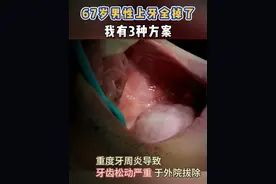 67岁男性上牙全掉了，我有3种方案！ #种植牙 #种牙视频封面