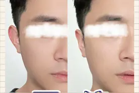 膨体精灵耳手术之后大概多久会发生回缩？ #精灵耳 #精灵耳手术 #变美 #八大处整形医生李川视频封面