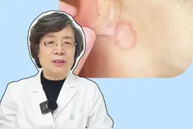 身上长圆形的红斑，越挠越痒，这不是过敏，而是会#传染 的#体癣  ！#湿疹 #皮肤 #硬核健康科普行动视频封面