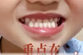 儿童地包天， 重点是早期矫正！ #正畸许跃 #地包天 #骨性地包天 #反颌 #早期矫治视频封面