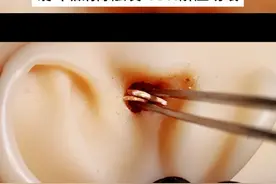 沉浸式大块硬耳垢清除模拟触发音轻松解压快速入睡 #asmr助眠视频视频封面