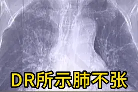 DR所示肺不张 什么是#肺不张呢？片子上怎么看？#医学影像#医学生