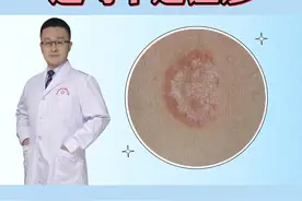 身上出现红色的丘疹，非常瘙痒，该怎么处理呢？#体癣 #医学科普 视频封面