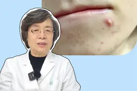 原来有的痘痘挤了好的更快！皮肤科医生教你正确处理不同类型的痘痘#痘痘 #脸上长痘 #医学科普 #科普 #皮肤