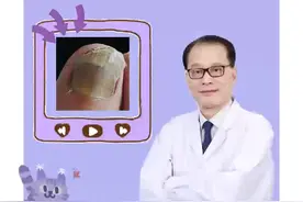 灰指甲越早越好治，治疗方法来了，快收藏备用！
#灰指甲 #一个传染俩  #灰指甲怎么办  #复方聚维酮碘搽剂  #盐酸特比萘芬片视频封面