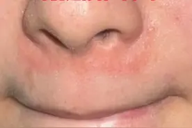 鼻翼两侧发红油腻还脱皮，这不是简单的#换季 干燥 #脂溢性皮炎用什么药 #护肤  #硬核健康科普行动   #女生必看视频封面