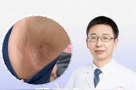 外用止汗剂两个月，腋窝受不了了 发红发痒，最后出现色沉，你们也有这种情况吗？#硬核健康科普行动   #秋季为健康迈步 #止汗剂 #腋下黑