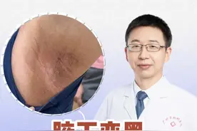 外用止汗剂两个月，腋窝受不了了 发红发痒，最后出现色沉，你们也有这种情况吗？#硬核健康科普行动   #秋季为健康迈步 #止汗剂 #腋下黑