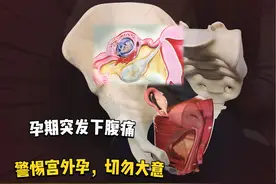 孕期突发下腹痛，警惕宫外孕可能，切勿大意 #解剖学 #医学生视频封面