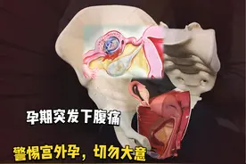 孕期突发下腹痛，警惕宫外孕可能，切勿大意 #解剖学 #医学生视频封面