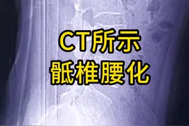 CT所示骶椎腰化 #医学影像 #医学生 #腰椎 #骶椎腰化 #医学科普视频封面