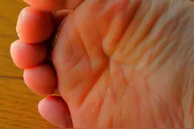 脚趾缝又痒又烂 闻着还臭臭的？协和皮肤科医生教你轻松解决！#皮肤科 #协和医院 #健康科普 视频封面