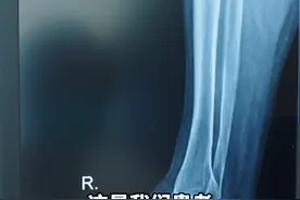 69岁踝关节炎，肿胀疼痛该怎么办？#踝关节炎 #医学科普 #足踝外科视频封面